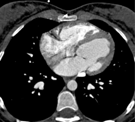 Pulmonary Embolism - CTisus CT Scan