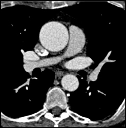 Pulmonary Embolism - CTisus CT Scan