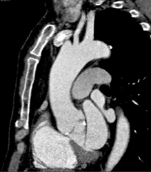 Dilated Aortic Root With Aortic Valve Calcifications - CTisus CT Scan