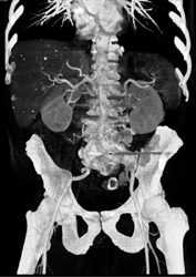 Diseased Aorta With Artifact From Metal ?? - CTisus CT Scan