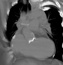 Aortic Valve Open and Closed - CTisus CT Scan