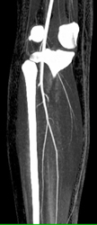 Normal Trifurcation With Bone Removal - CTisus CT Scan