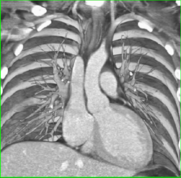 Superior Intercostal Aa - CTisus CT Scan