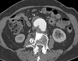 Ulcer in Aortic Aneurysm - CTisus CT Scan