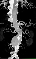 Abdominal Aortic Aneurysm (AAA) - CTisus CT Scan