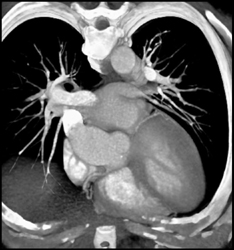 Calcified Aortic Valve - CTisus CT Scan