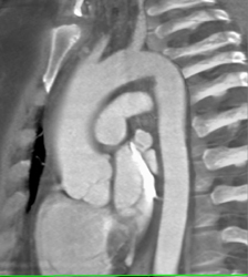 Dilated Ascending Aorta - CTisus CT Scan