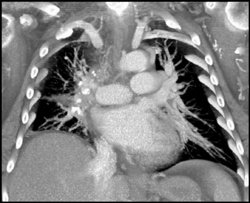 SVC Occlusion - CTisus CT Scan