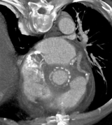 Post Aortic Root Repair W/o Abscess - CTisus CT Scan