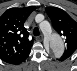 Type B Dissection - CTisus CT Scan