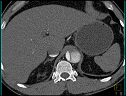 Type B Dissection - CTisus CT Scan