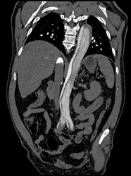 Type B Dissection - CTisus CT Scan