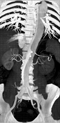 Type B Dissection - CTisus CT Scan