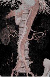 Type B Dissection - CTisus CT Scan