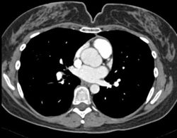 Loeys-Dietz Syndrome With Vascular Change in SMA Branches-vasculitis - CTisus CT Scan