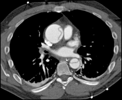 Type A Dissection - CTisus CT Scan