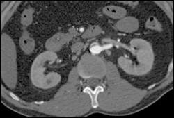 Type A Dissection - CTisus CT Scan