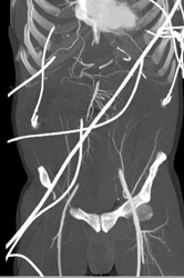 Diseased Iliacs of ?? - CTisus CT Scan