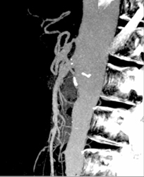 Celiac Stenosis - CTisus CT Scan