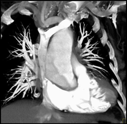 Encased Pulmonary Aa - CTisus CT Scan