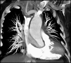 Type A Dissection - CTisus CT Scan