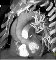 Type A Dissection - CTisus CT Scan