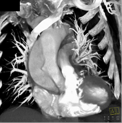 Type A Dissection - CTisus CT Scan