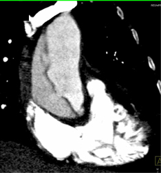 Type A Dissection - CTisus CT Scan