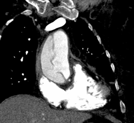 Type A Dissection - CTisus CT Scan