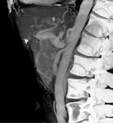 Dilated Celiac Artery With Proximal Stenosis - CTisus CT Scan