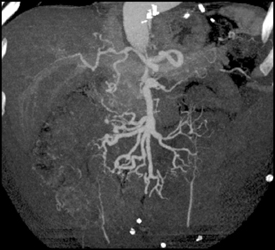 Increased Flow Into Mesenteric Vessels - CTisus CT Scan