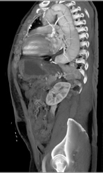 Type B Dissection - CTisus CT Scan