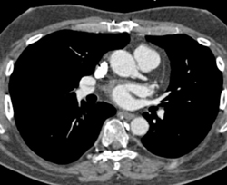 Pseusolesion Off Artifact in SVC - CTisus CT Scan