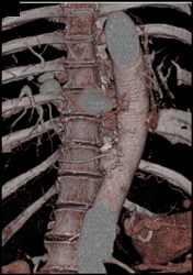 Artery of Adamkawitz - CTisus CT Scan