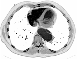 Type B Dissection - CTisus CT Scan