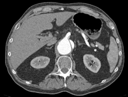 Type B Dissection - CTisus CT Scan