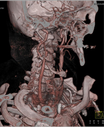 Carotid Stenosis - CTisus CT Scan