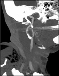 Carotid Stenosis - CTisus CT Scan