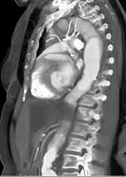 Aneurysm Off the Arch - CTisus CT Scan