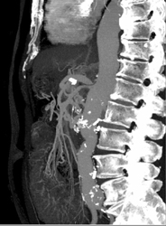 Median Arcuate Ligament Syndrome in Patient With An Abdominal Aortic Aneurysm (AAA) - CTisus CT Scan