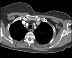 Takayasu's Arteritis - CTisus CT Scan