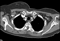 Takayasu's Arteritis - CTisus CT Scan