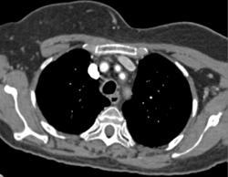 Takayasu's Arteritis - CTisus CT Scan