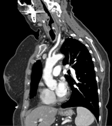 Takayasu's Arteritis - CTisus CT Scan