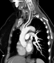 Takayasu's Arteritis - CTisus CT Scan