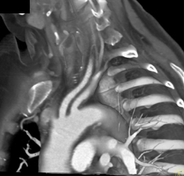 Takayasu's Arteritis - CTisus CT Scan