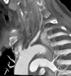 Takayasu's Arteritis - CTisus CT Scan