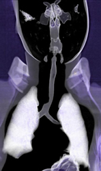 Right Aortic Arch-trachea - CTisus CT Scan