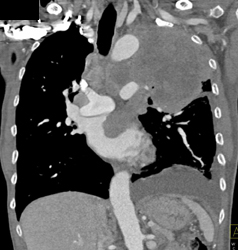 Lung Cancer Invades the Atrium - CTisus CT Scan