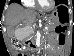 Hepatic Artery Aneurysm - CTisus CT Scan